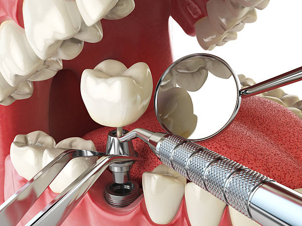 Best Emergency Tooth Extraction in Estherville, IA